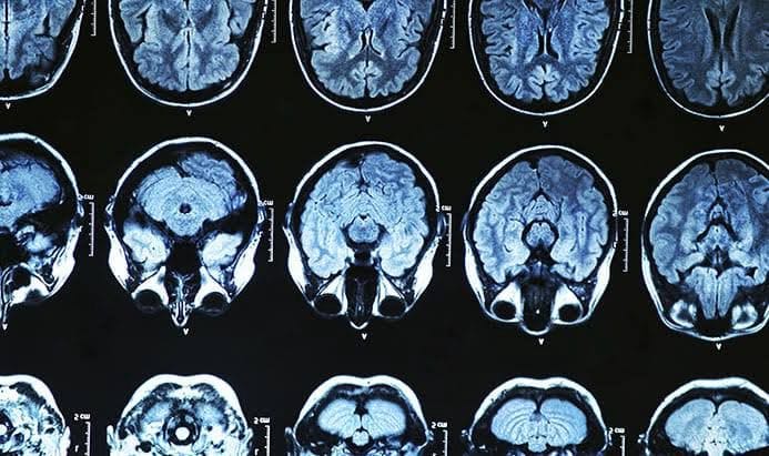Novo medicamento para Alzheimer chega ao Brasil com promessa de retardar evolução da doença